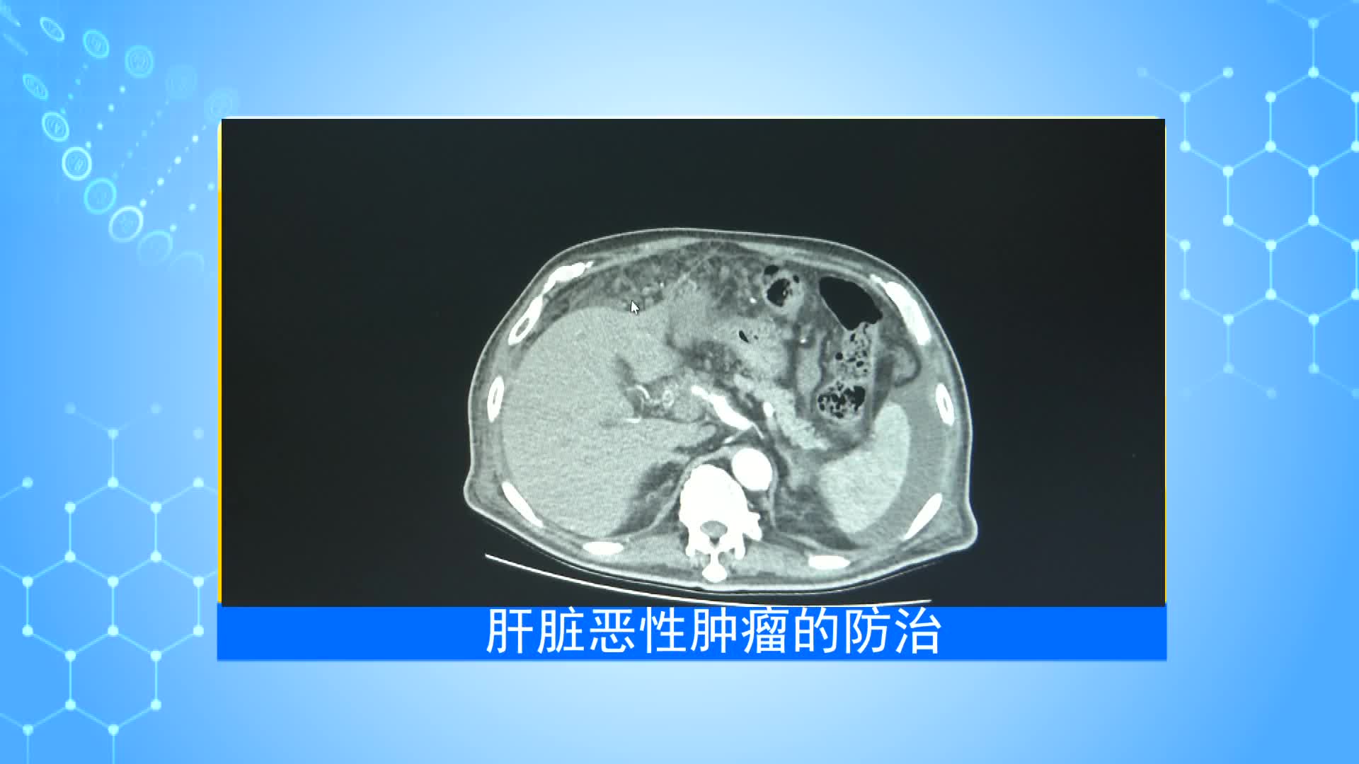 《第1健康》第60期：它占肿瘤死亡率第二位，该如何远离？