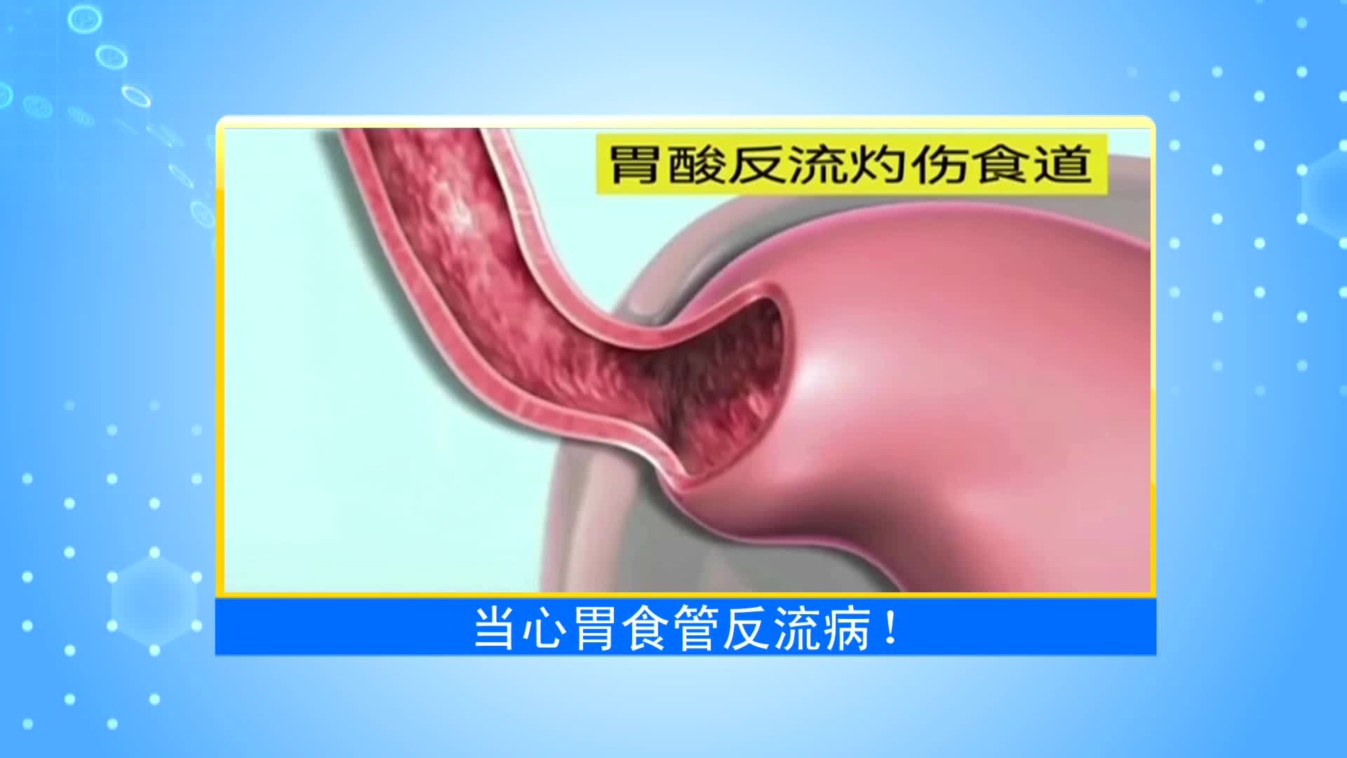 《第1健康》第33期：胃食管反流：胃里的“阀门”坏了