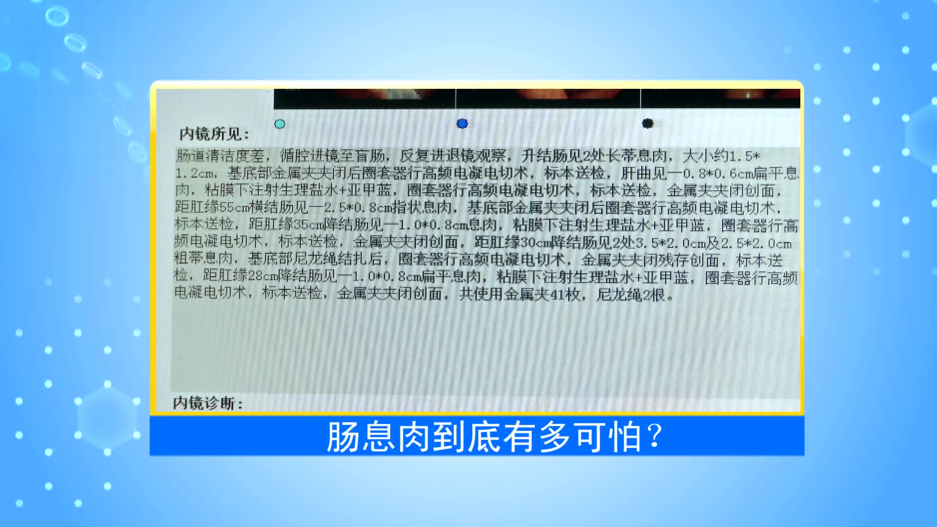 《第1健康》第39期：大肠息肉知多少？