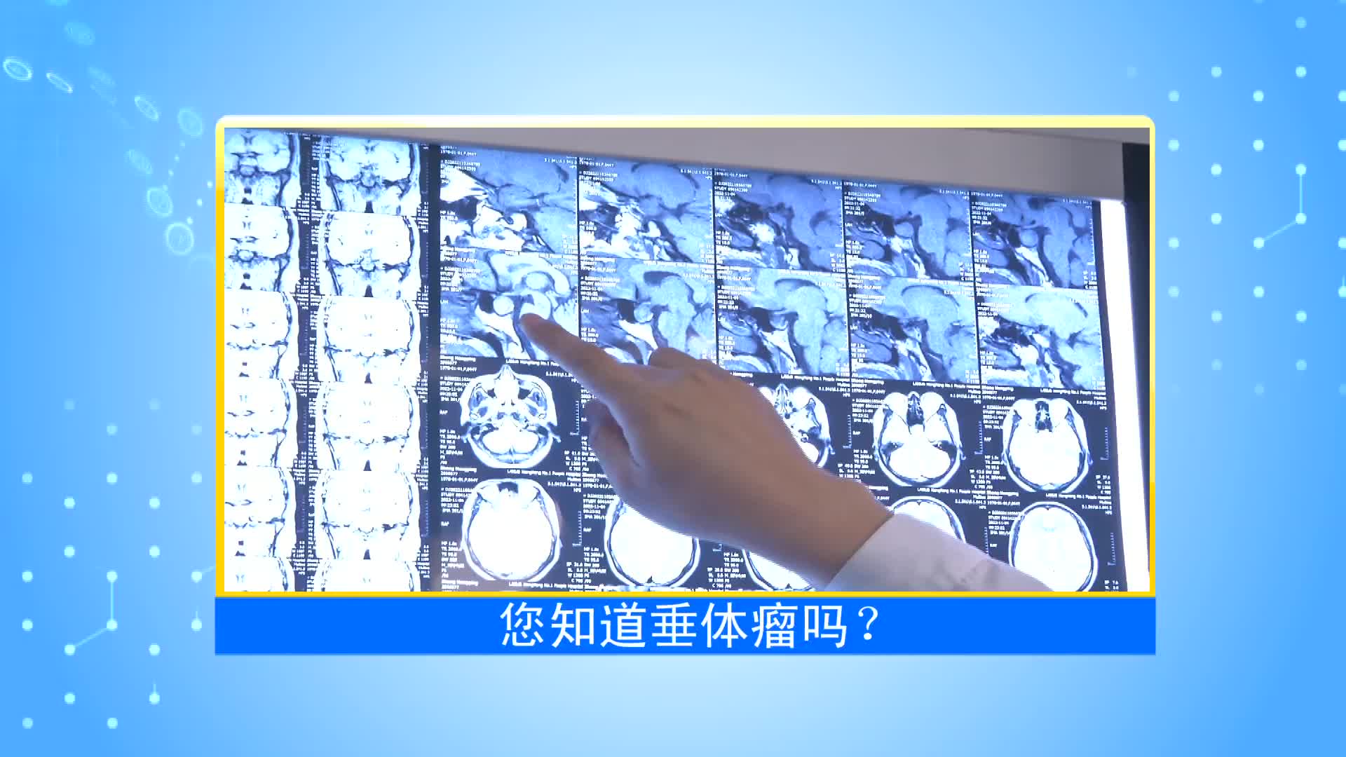 《第1健康》第52期：容易“忽视”的脑部肿瘤--垂体瘤