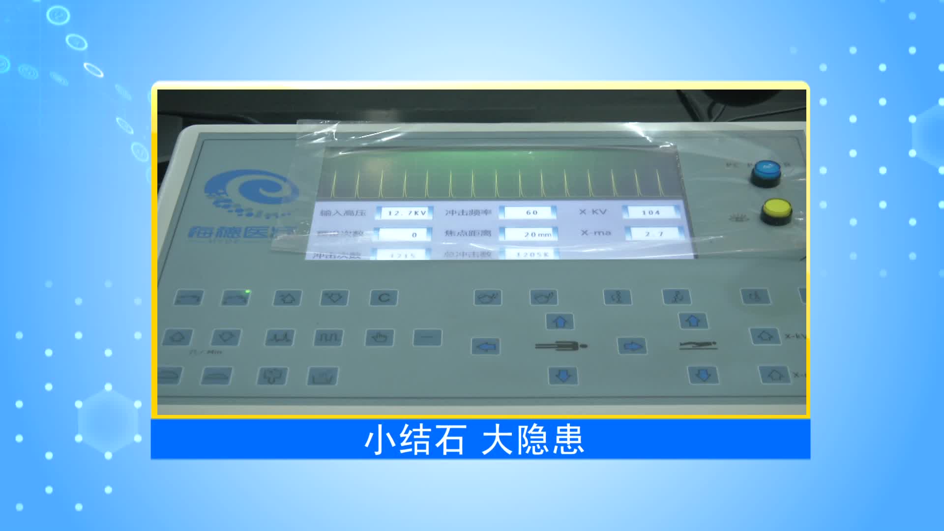 《第1健康》第19期：输尿管结石：小结石 大隐患