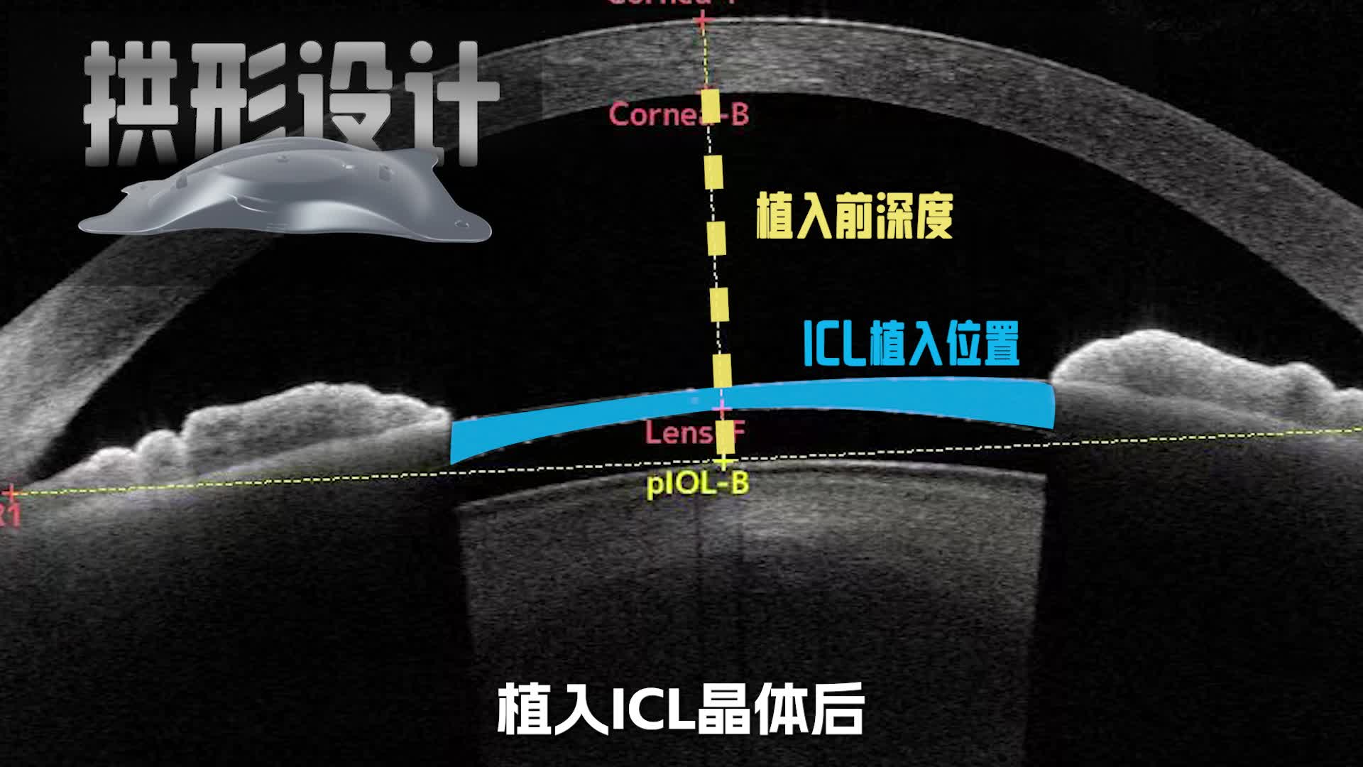 ICL近视手术:前房深度多少正常，又受哪些因素左右?