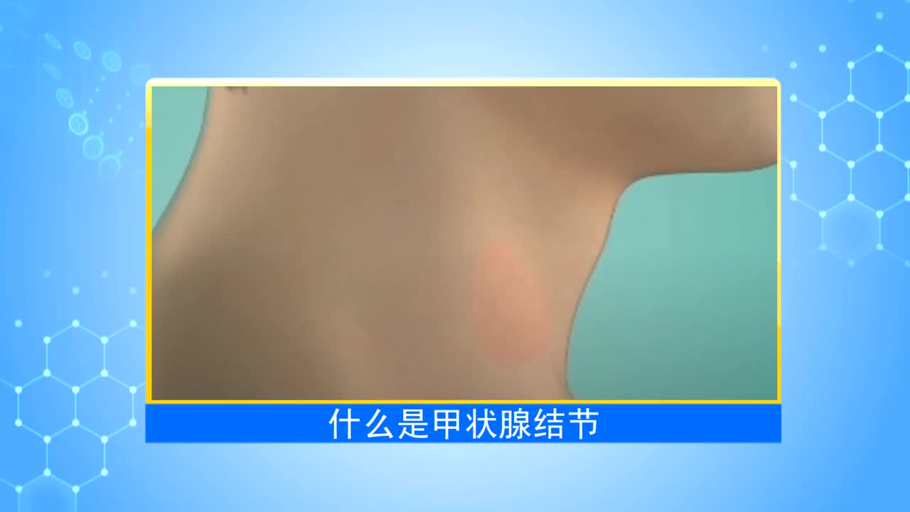 《第1健康》第12期：这些甲状腺结节误区要规避