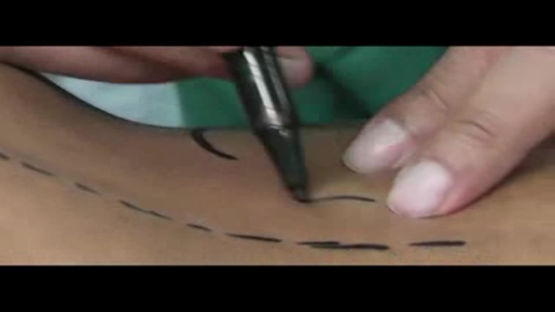 我院成功完成首例复杂脊柱畸形矫正手术