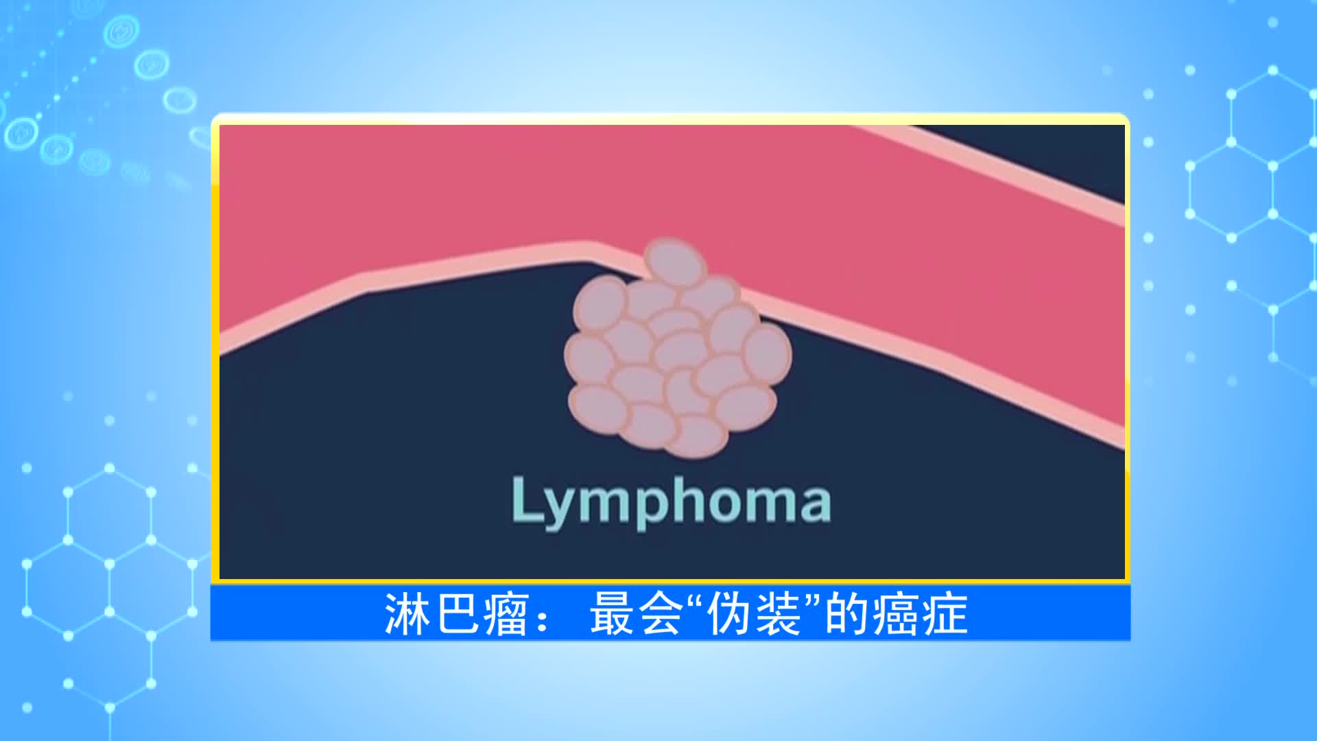 《第1健康》第35期：淋巴瘤——肿瘤界的“伪装者”