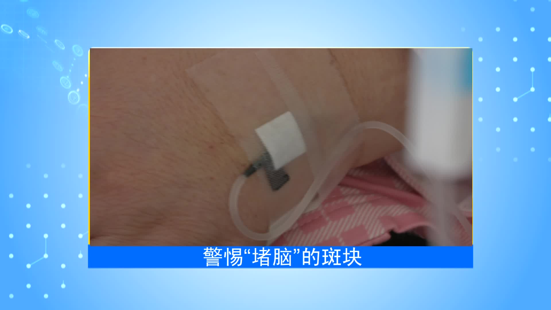 《第1健康》第85期：这里“长斑”是危险信号，半数中风和它有关