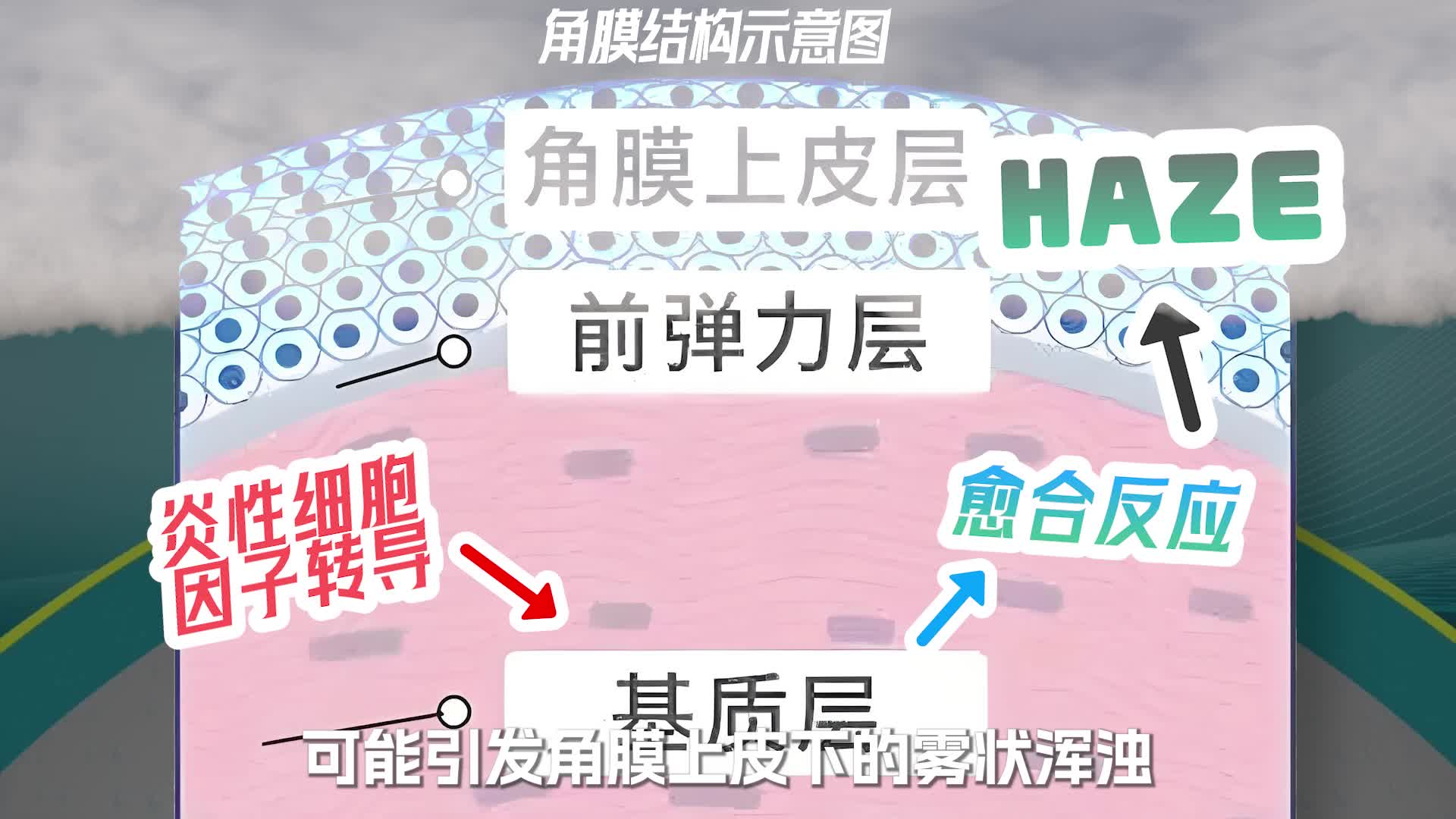 全激光术后为什么强调戴墨镜