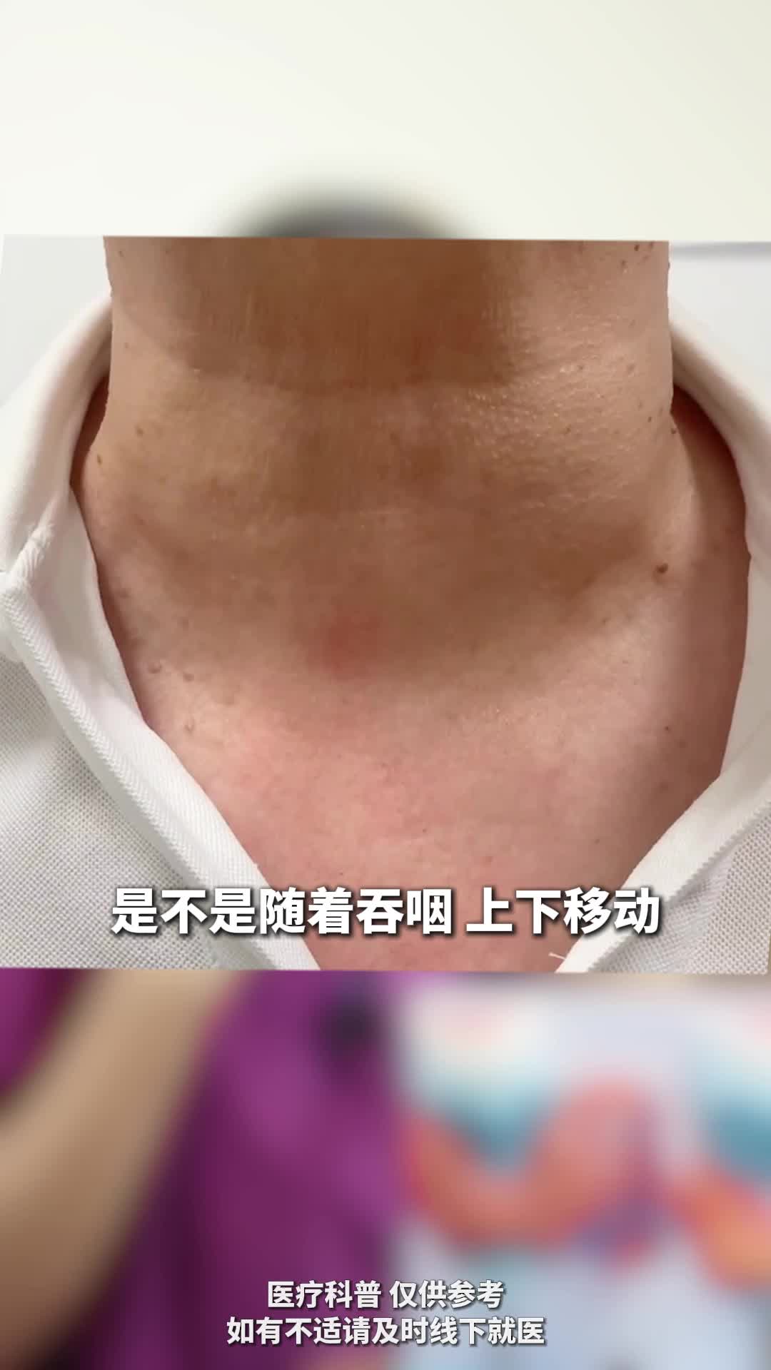 简单两步教你自查甲状腺