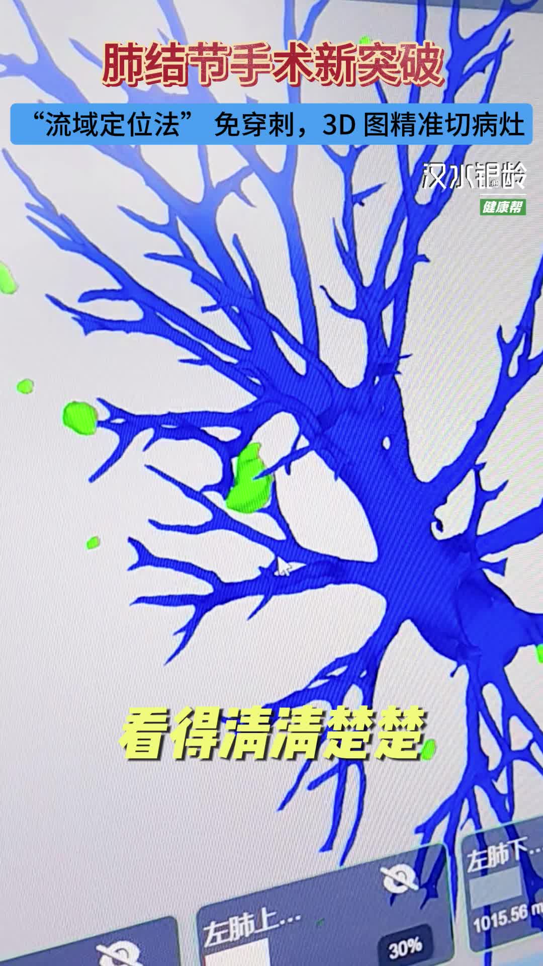 新质医疗服务力之八丨肺结节手术新突破，“流域定位法”免穿刺，3D图精准切病灶
