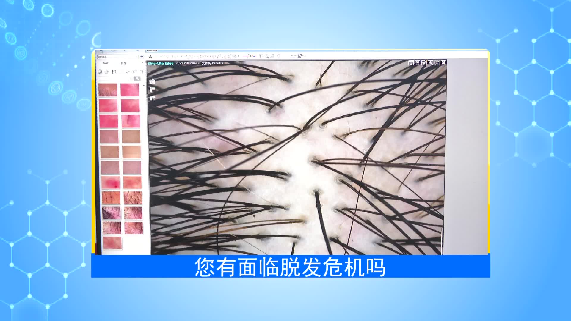 《第1健康》第22期：面对脱发烦恼 该如何应对